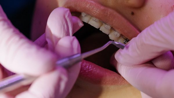 Ways to Clean Your Teeth when Wearing Braces