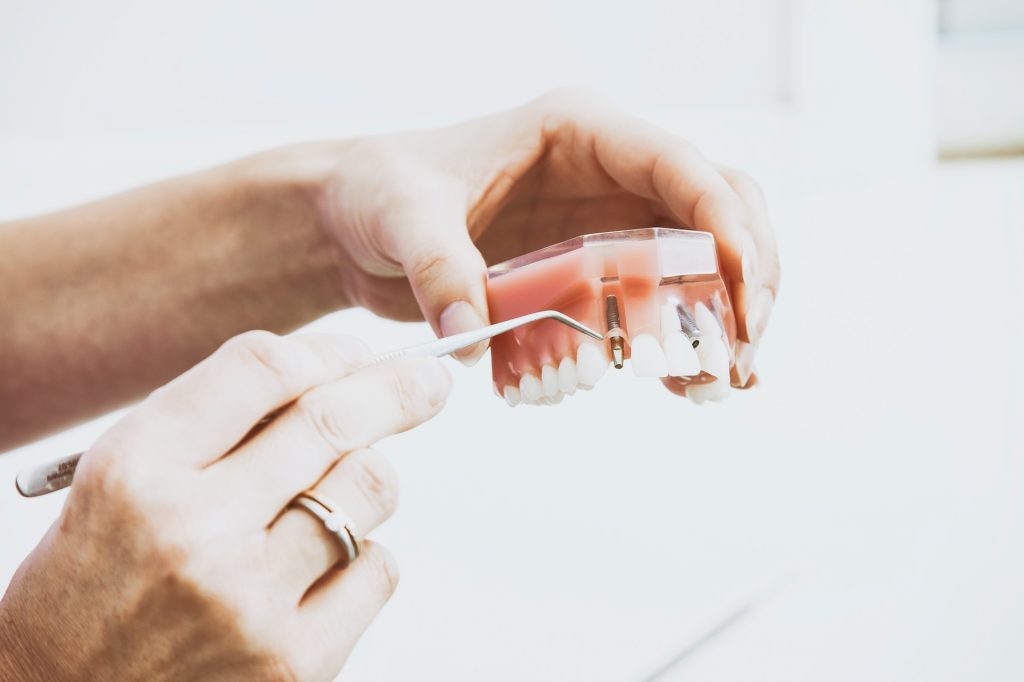 Alternatives to Dental Veneers