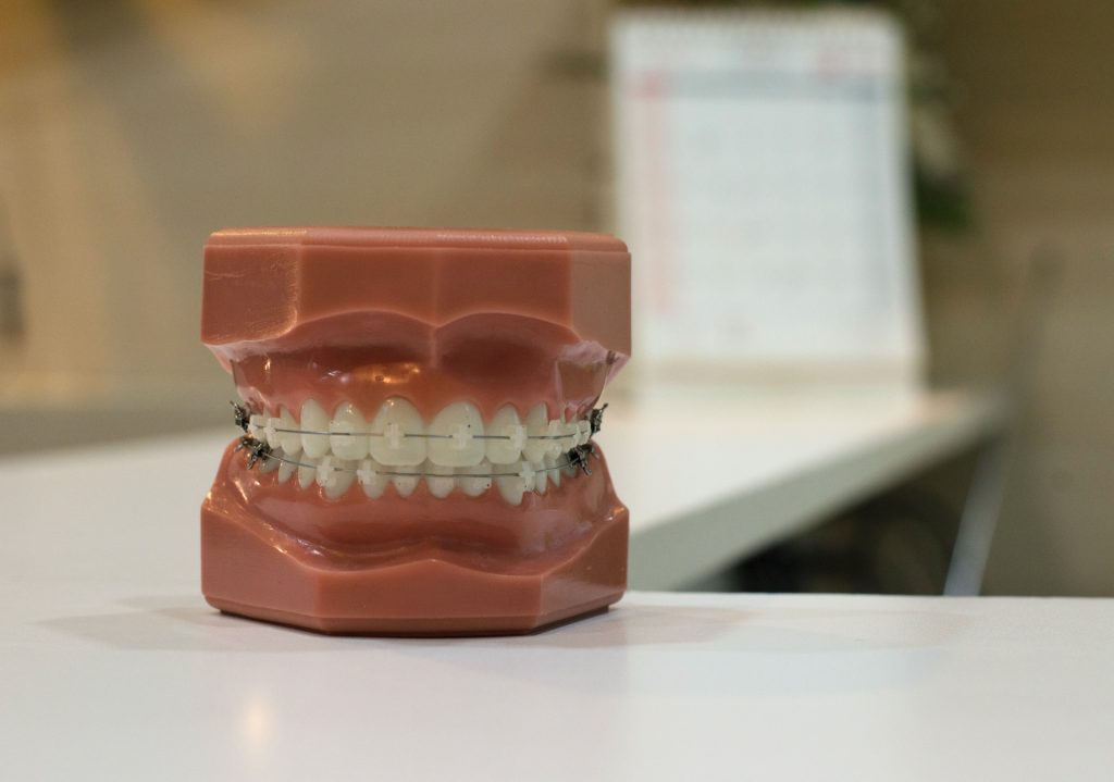 Process of Getting Dental Veneers